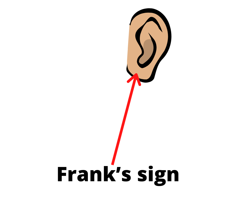 Frank’s sign